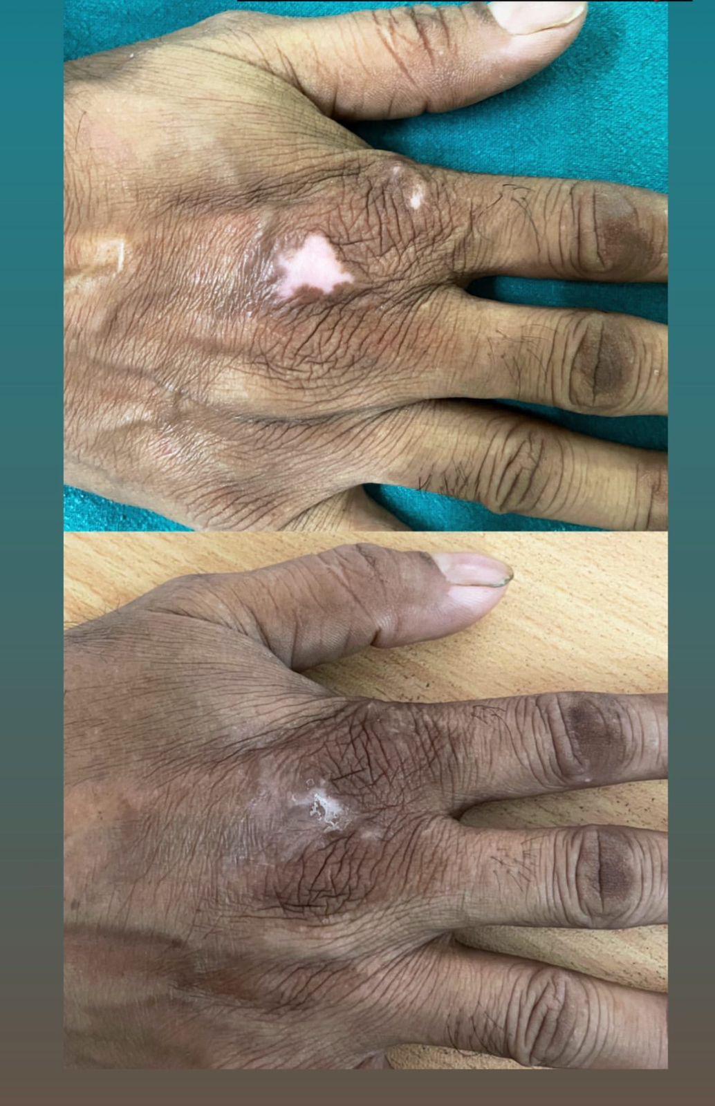 Treatment spotlight case 04