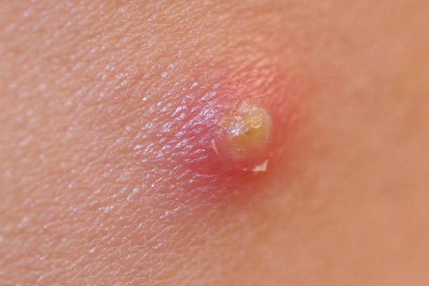 Treating boils on the skin