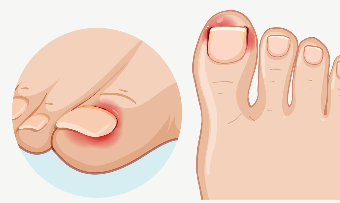 Ingrown nail care