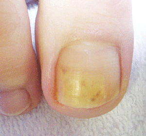 Fungal nail treatment