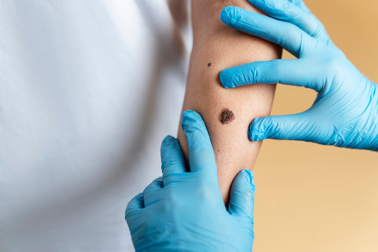 Wart removal procedures